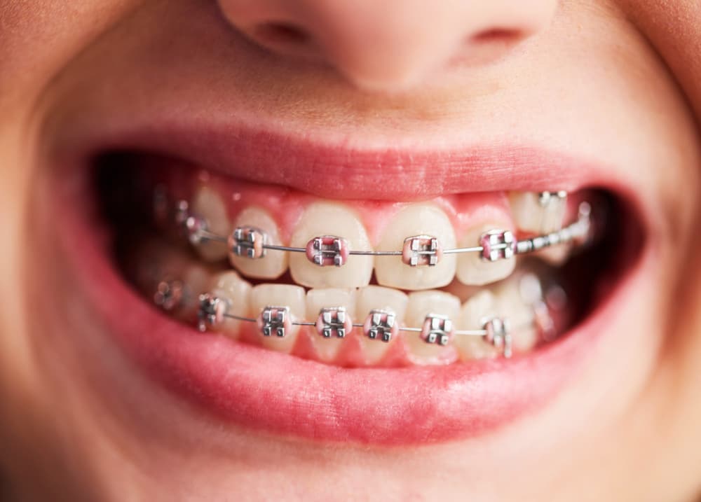 Damon Braces