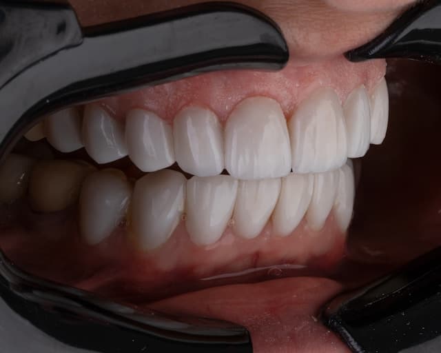 Dentures