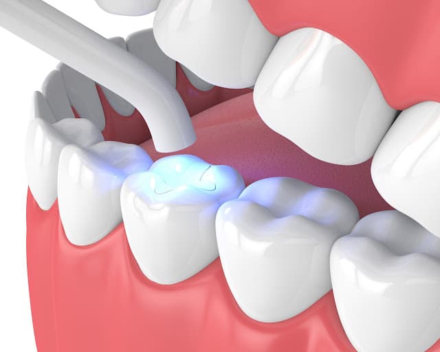Dental Fillings