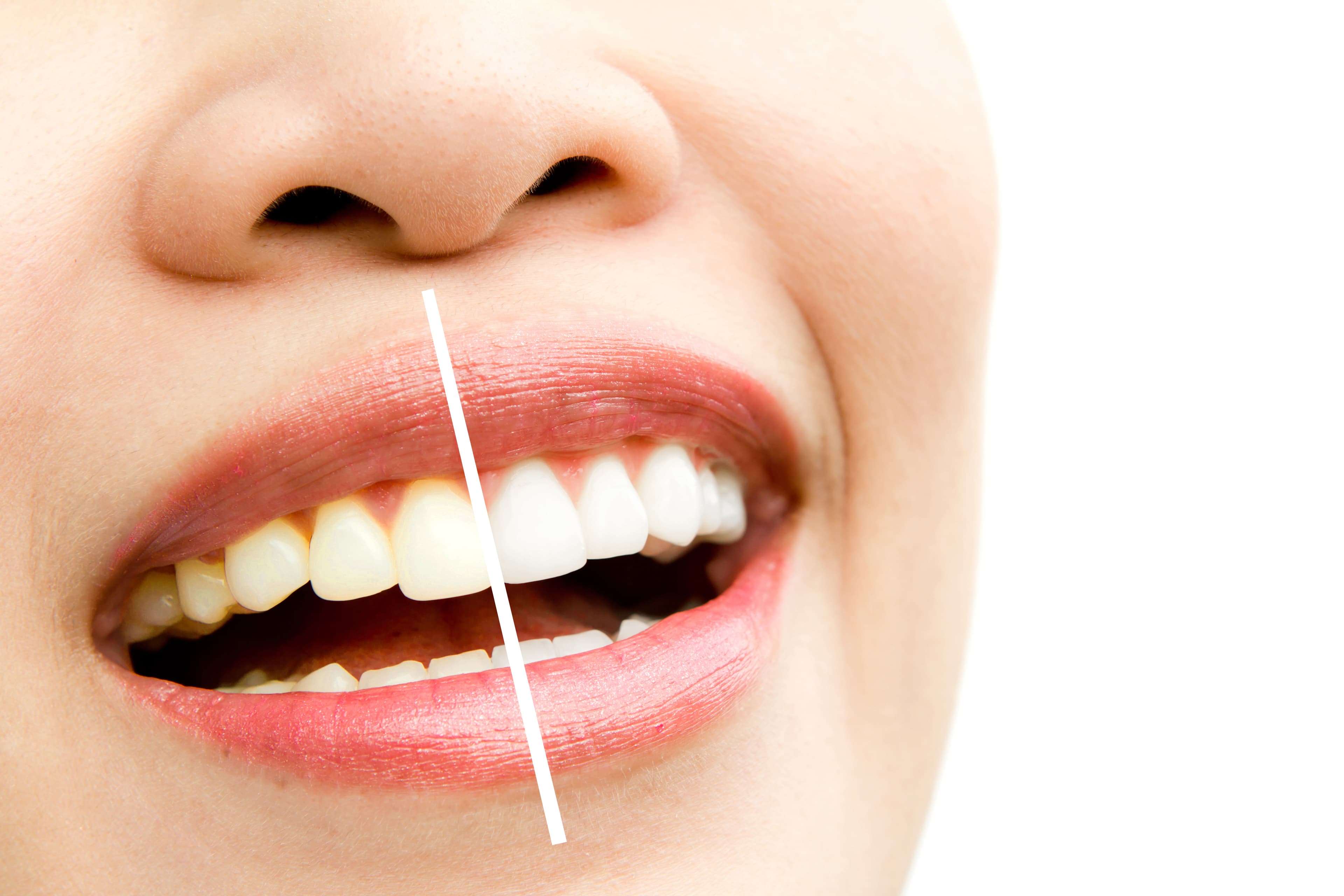 Professional Teeth Whitening Treatments