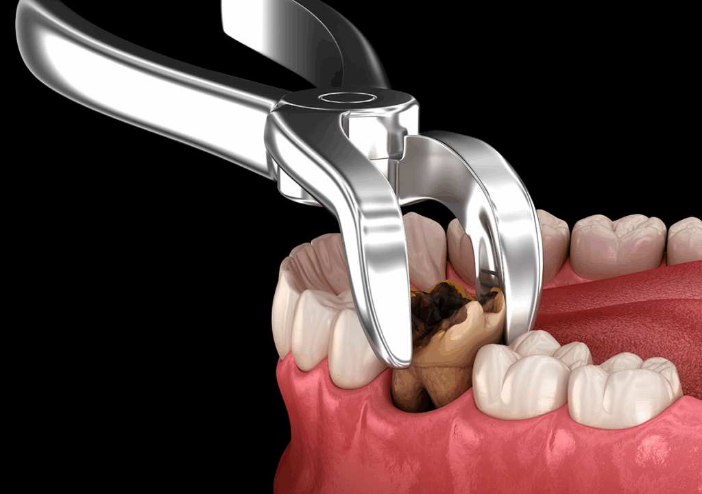 Tooth Extractions