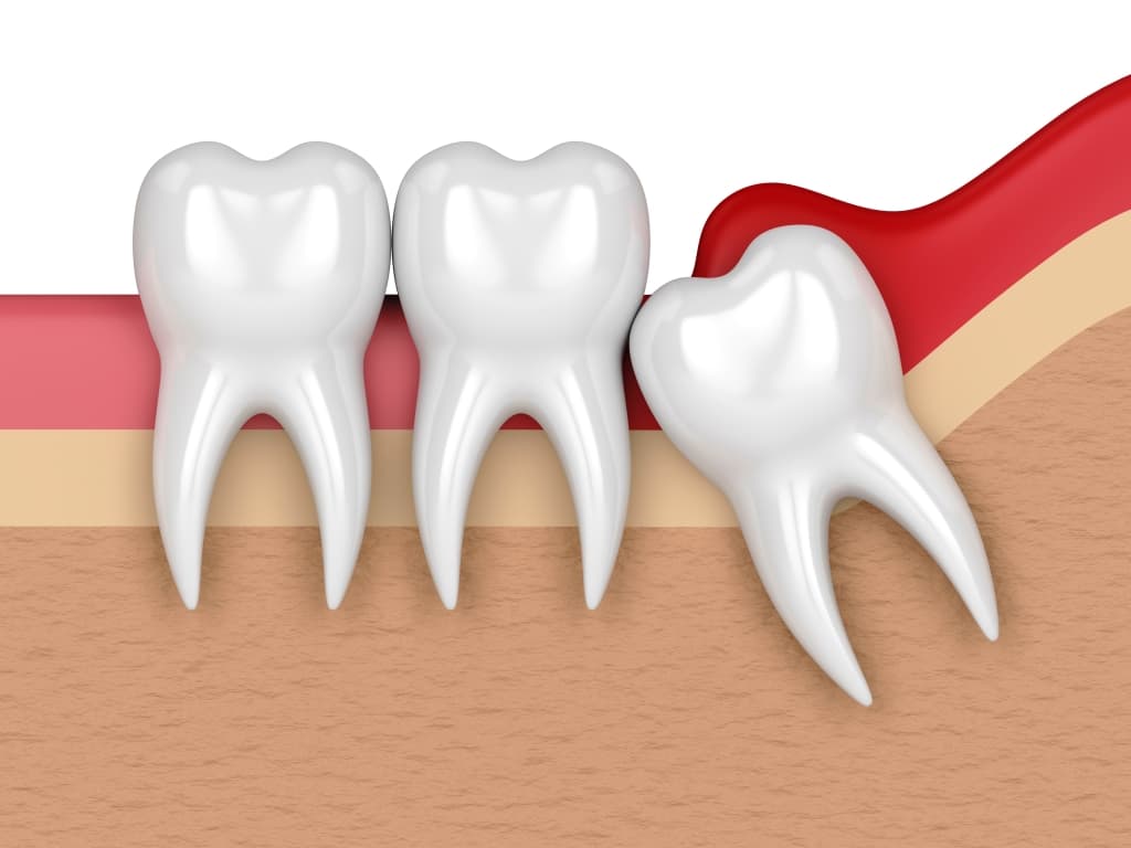 Wisdom Tooth Removal / Extraction